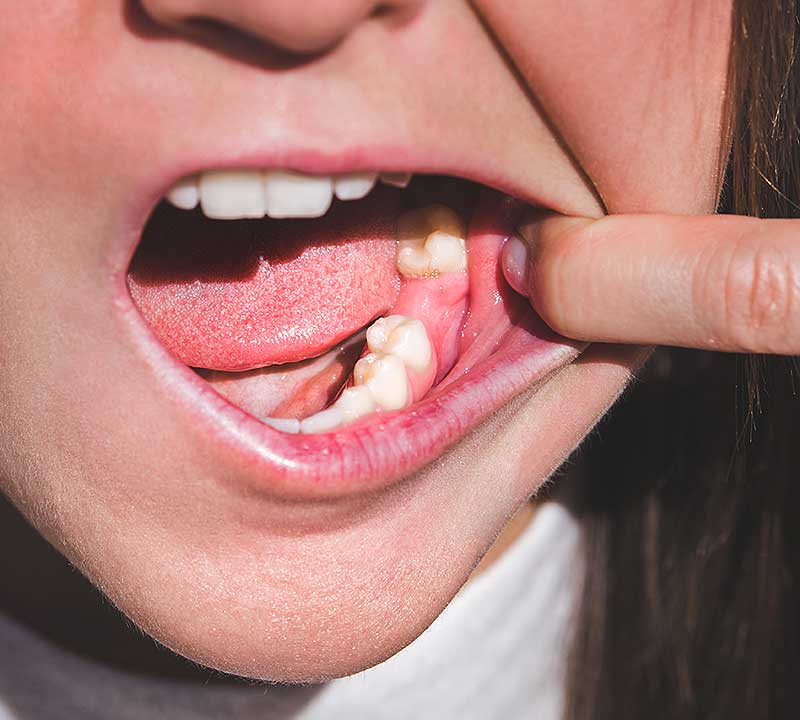 Dental Implants in Moggill